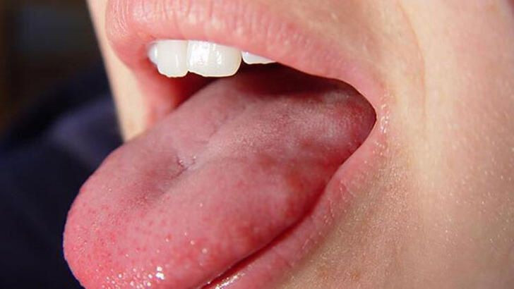 Dilde kabarcıklar neden olur? Nasıl geçer? - Resim: 1