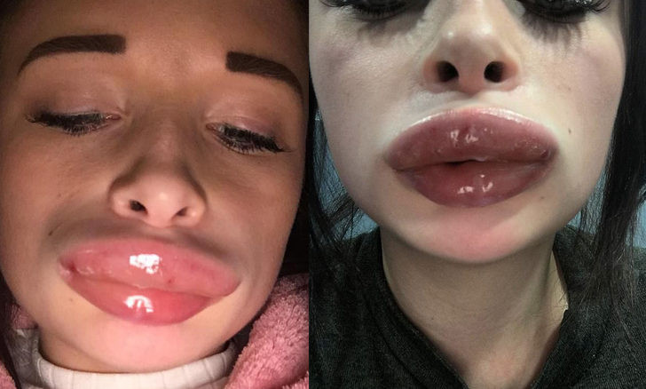 Dudak dolgusu konuşamaz hale getirdi! - Resim: 1