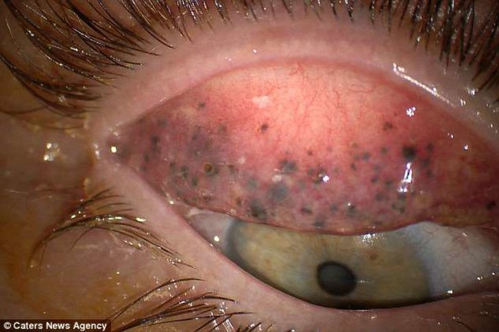 25 yıldır sürdüğü rimeli temizlemeyince az kalsın kör oluyordu - Resim: 4