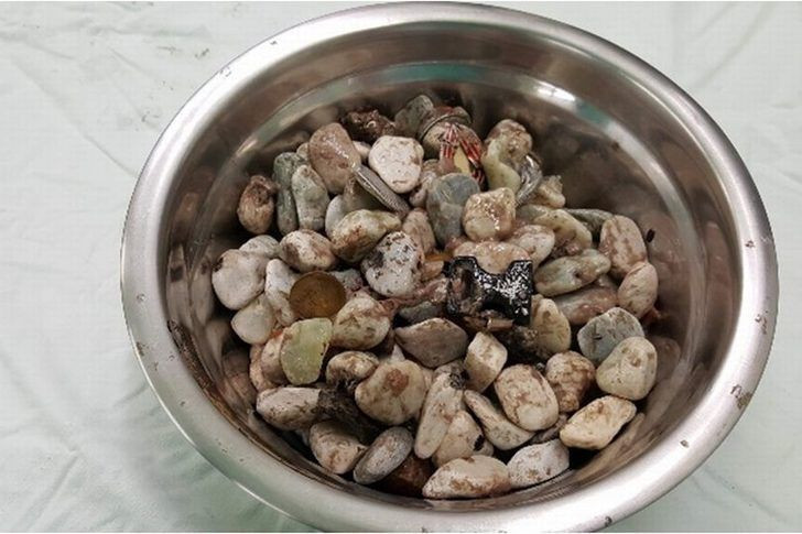 Midesinden çıkanı duyunca şoke olacaksınız! Tam 2 kilo - Resim: 4