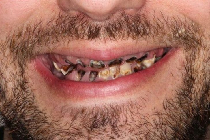 Günde 6 litre kola onu öyle bir hale getirdi ki.. - Resim: 3