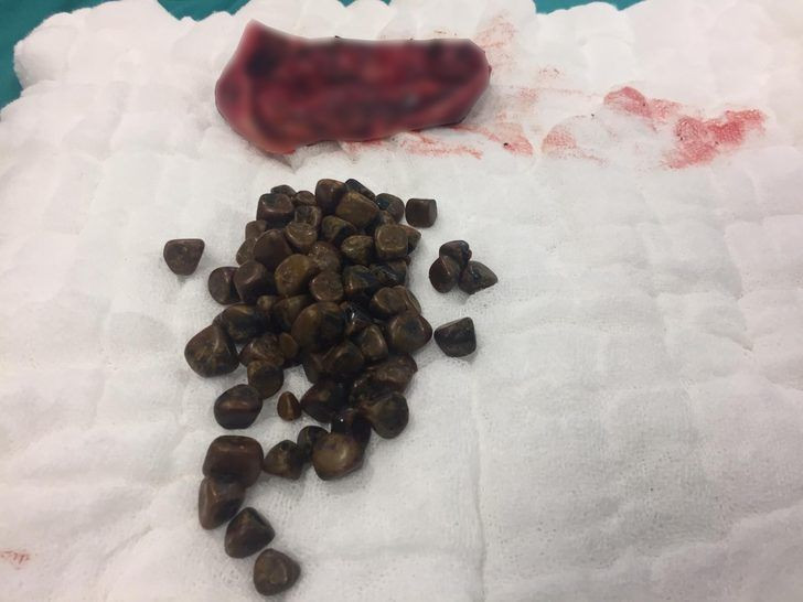 Antalya'da akılalmaz olay Ameliyatla çıkardılar tam 86 tane - Resim: 1