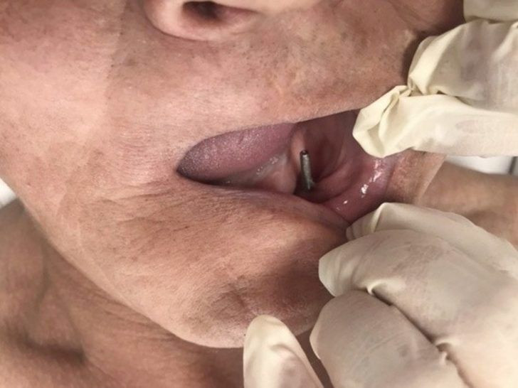İmplant yerine sanayi tipi vida takmışlar! 28 yıl sonra öğrendi - Resim: 2