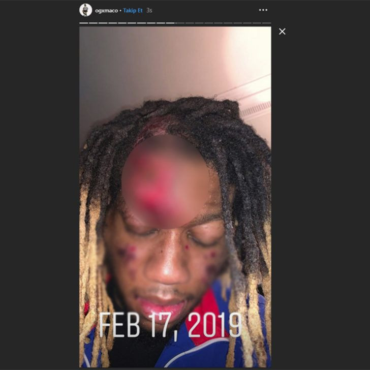 Ünlü şarkıcı et yiyen bakteri kaptı! Yüzünü yemeye başladı hızla yayılıyor - Resim: 3