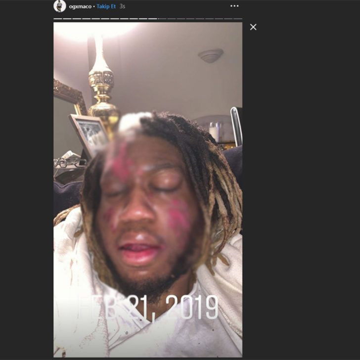 Ünlü şarkıcı et yiyen bakteri kaptı! Yüzünü yemeye başladı hızla yayılıyor - Resim: 4