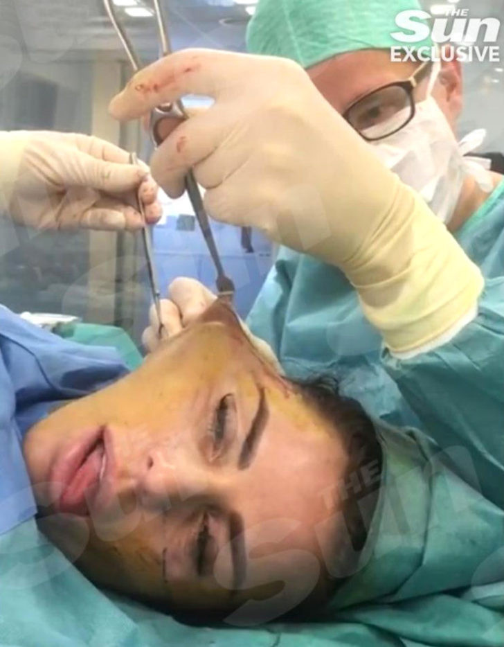 Katie Price yüz germe ameliyatını yayınladı! - Resim: 1