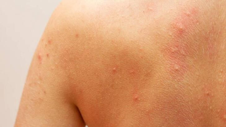 Ürtiker bahar aylarında daha sık görülüyor! - Resim: 2