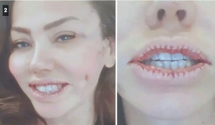 Şarkıcı Lara estetikle dudaklarını küçültmüştü eleştirilere isyanı bastı - Resim: 3