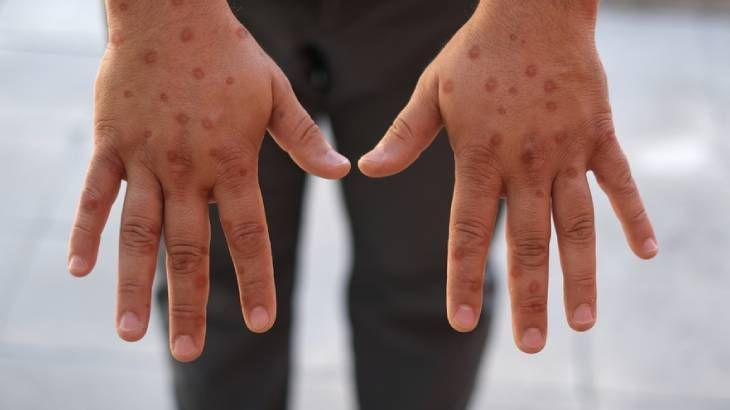 Bakanlık, maymun çiçeği ile ilgili merak edilen soruları cevapladı - Resim: 1