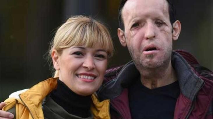 Yüz nakilli Recep Sert'ten kötü haber! Eşi Esma Sert açıkladı - Resim: 4