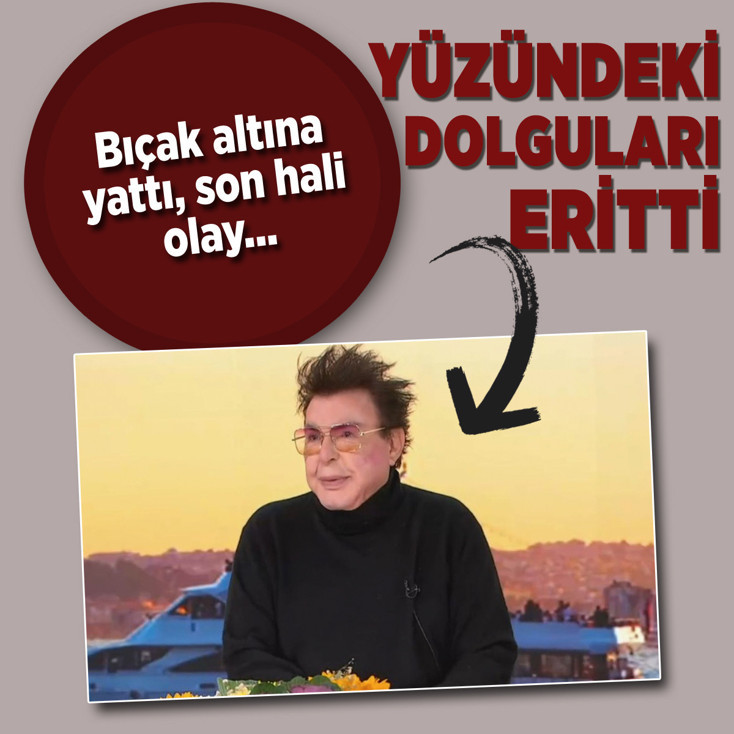 Kuşum Aydın yüzüne yaptırdığı tüm dolgulardan kurtuldu, ameliyat oldu! Son hali olay...