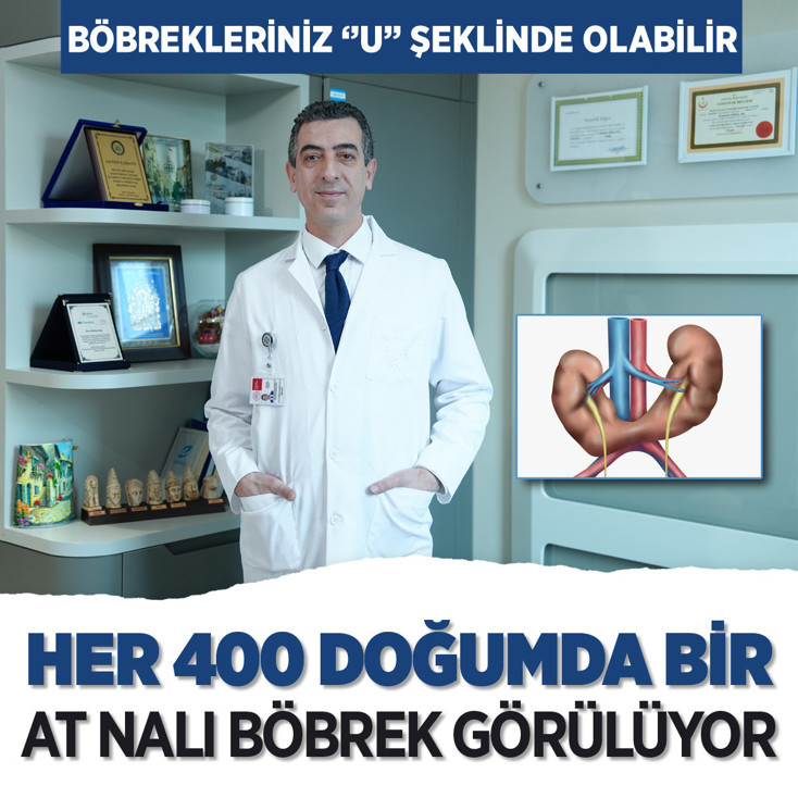 Böbrekleriniz "U" şeklinde olabilir mi? Her 400 doğumda bir at nalı böbrek görülüyor