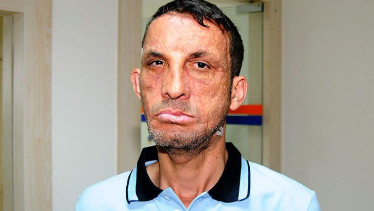 Türkiye'nin ilk yüz nakliydi! Uğur Acar'ın son hali görenleri şaşkına çevirdi - Resim: 4