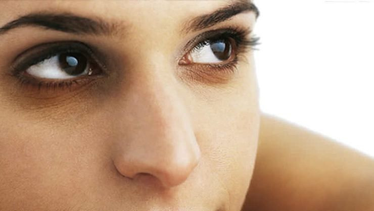 Göz altı morlukları neden oluşur ve nasıl giderilir? - Resim: 3