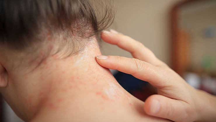 Strese bağlı egzama nasıl geçer tedavisi - Resim: 3