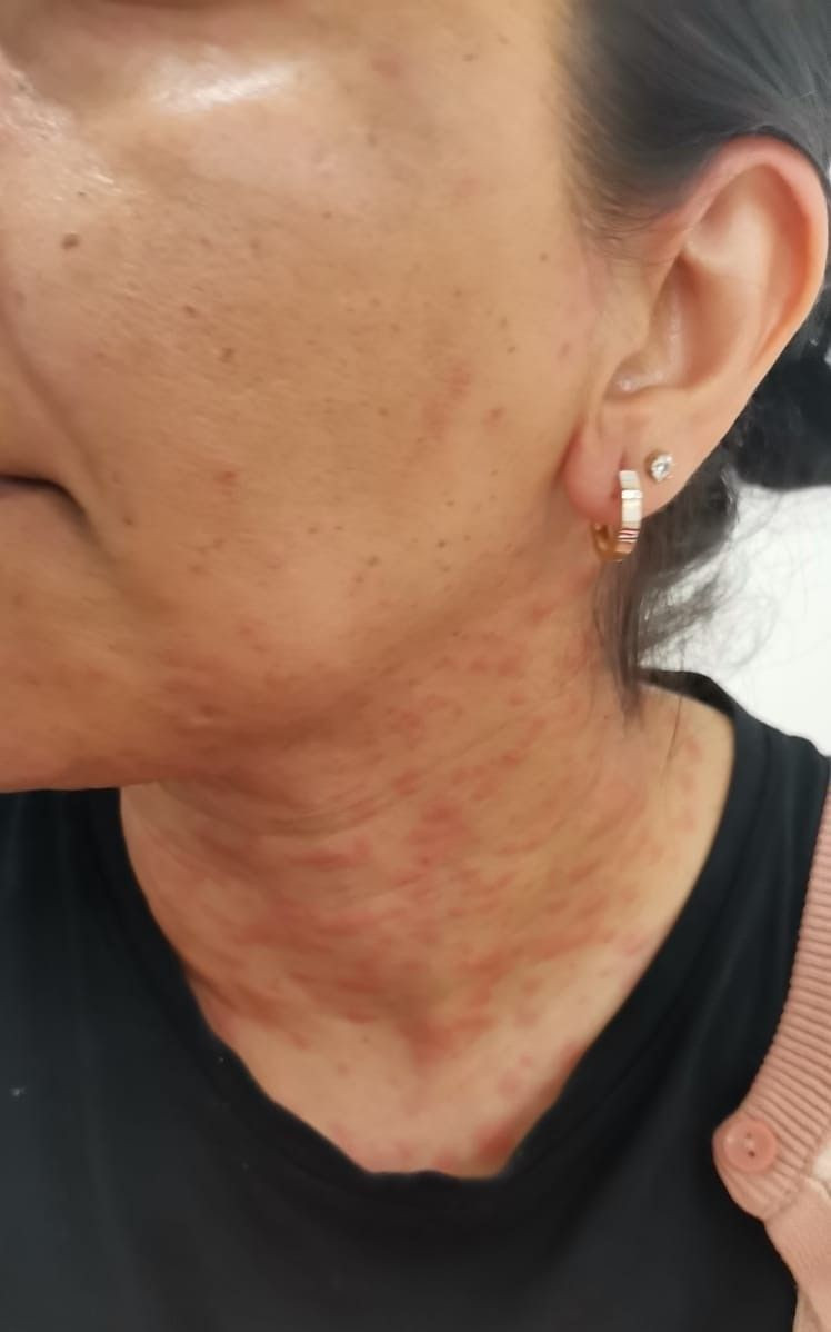 Antalya'da evinin bahçesindeki tırtılları süpüren kadın hastanelik oldu: Yüzüm alev topu gibi oldu - Resim: 2