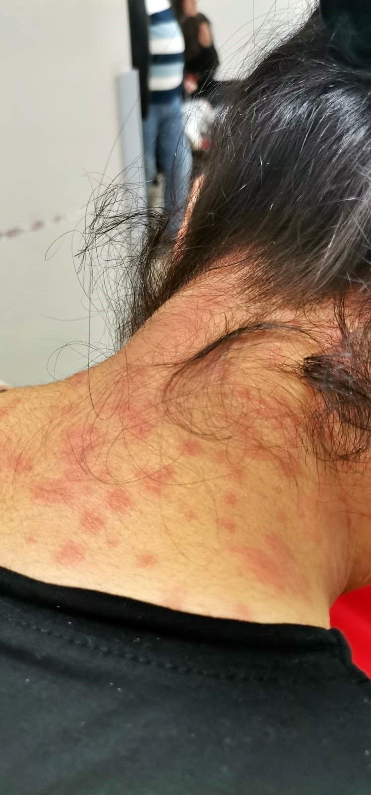 Antalya'da evinin bahçesindeki tırtılları süpüren kadın hastanelik oldu: Yüzüm alev topu gibi oldu - Resim: 4