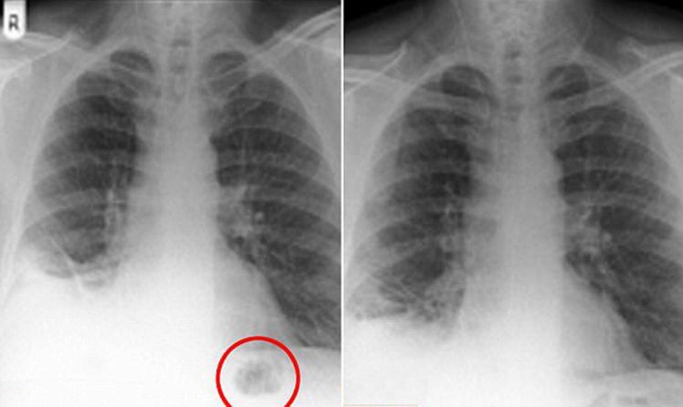 Tıp tarihi bunu da gördü ciğerinden trafik konisi çıktı - Resim: 1