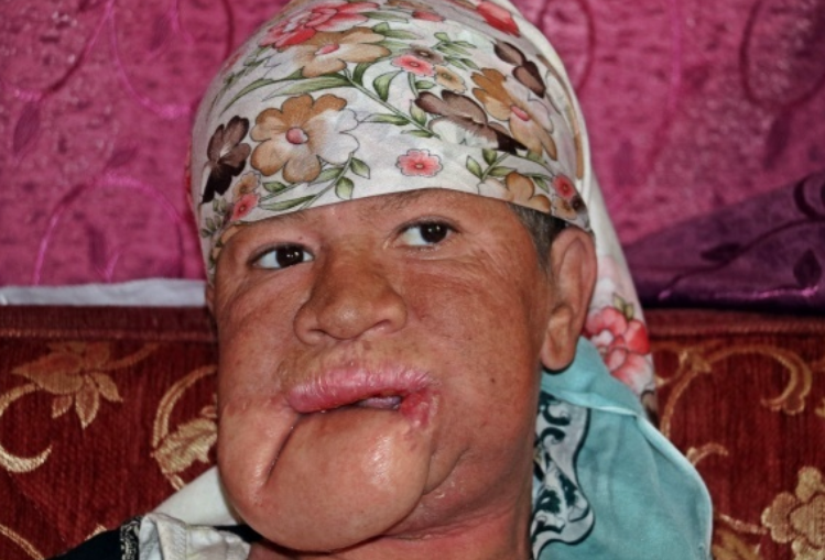 Çenesinde çıkan sivilce hayatını kabusa çevirdi! - Resim: 2