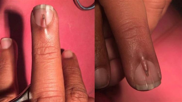 Tırnağının üstünde tırnak çıktı - Resim: 1