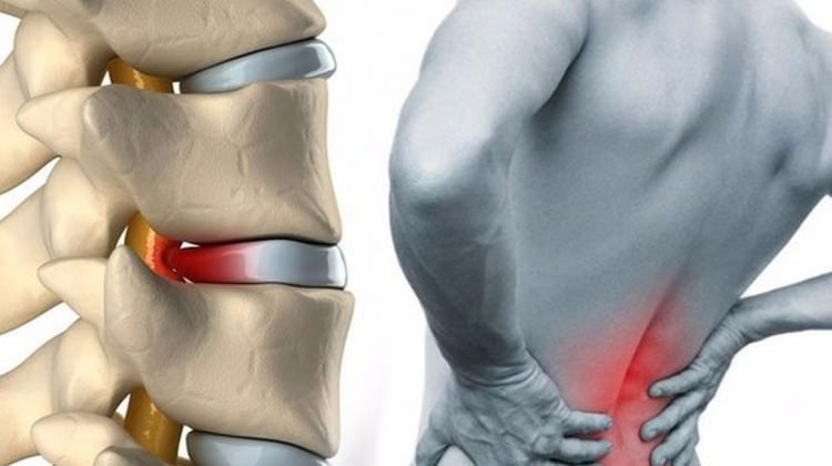 Bel fıtığına sebep olan 4 neden aman bunlardan uzak durun! - Resim: 3