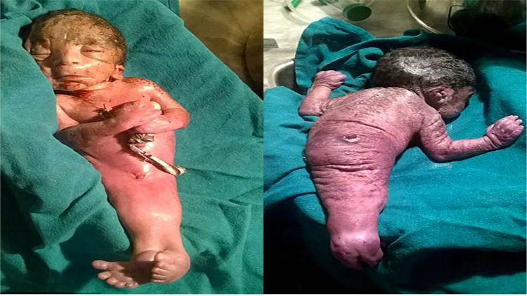 Hindistan'da doğan garip bebek doktorlar cinsiyetini tespit edemedi - Resim: 3