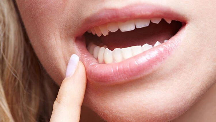 Diş eti iltihabı neden olur nasıl geçer? - Resim: 3