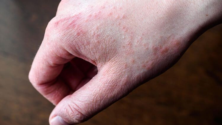 Strese bağlı egzama nasıl geçer tedavisi - Resim: 1