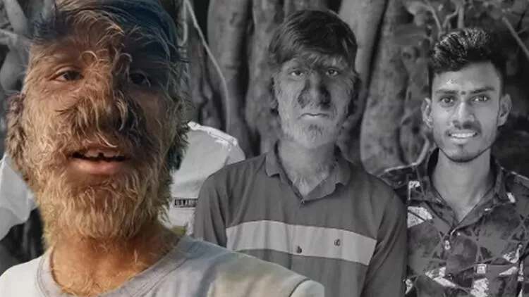 Sadece 50 kişide görülen hastalık! Kurt Adam hayat hikayesini anlattı: "İnsanlar üzerime taş atardı, hayalim Youtuber olmak" - Resim: 1