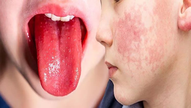 Türkiye'de ilk ölüm! Strep A bakterisi 3 yaşındaki Aras'ı öldürdü! Aras'taki belirtileri nelerdi? - Resim: 1