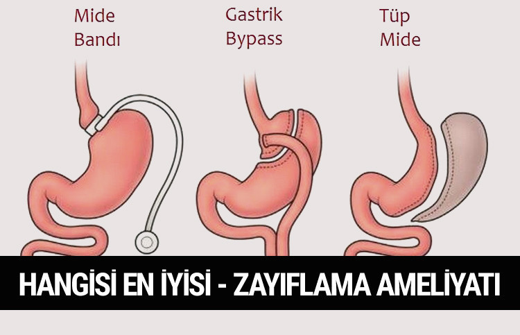 Tüp mide gastrik bypass ve kelepçe ameliyatı nedir hangisi iyi? - Resim: 1