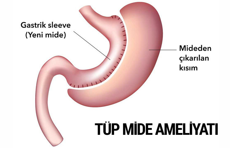 Tüp mide gastrik bypass ve kelepçe ameliyatı nedir hangisi iyi? - Resim: 2