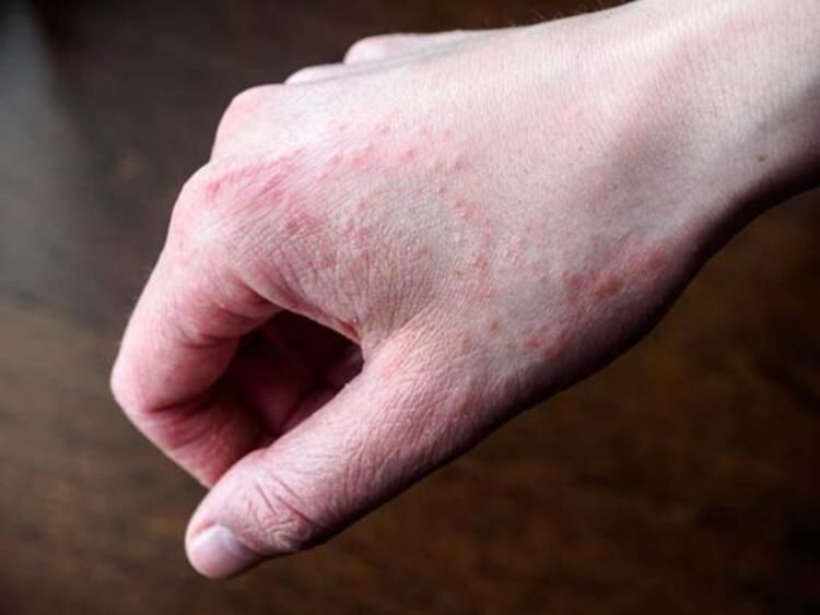 Koronavirüsten korunurken tetiklenen 7 cilt sorununa dikkat! - Resim: 2