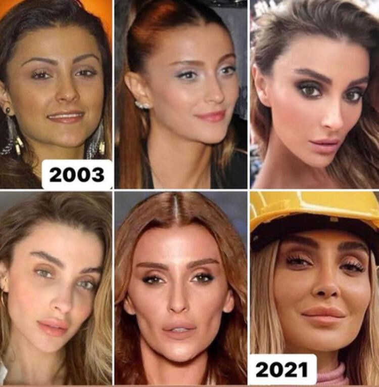 Özge Ulusoy 'ilk estetiğim' deyip paylaştı yine kimse inanmadı olay değişim - Resim: 1