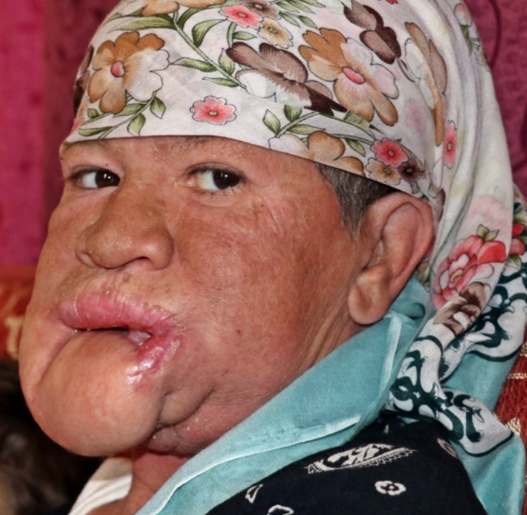 Çenesinde çıkan sivilce hayatını kabusa çevirdi! - Resim: 1