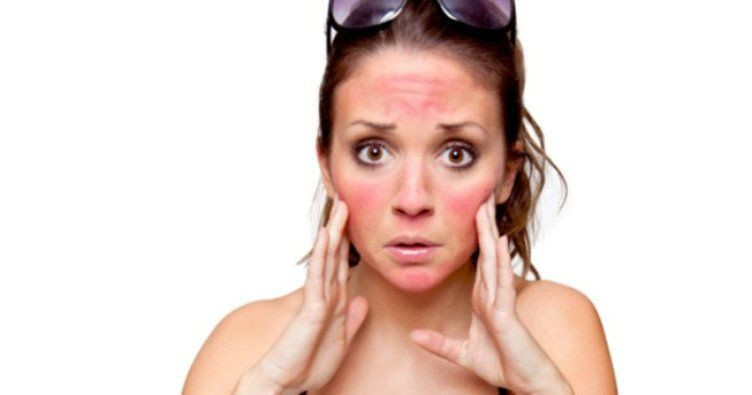 Güneş yanığına ne iyi gelir? Doğru bilinen yanlışlar! - Resim: 4