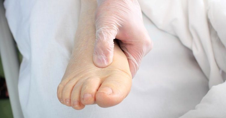 Ödem nedir vücuttan nasıl atılır? - Resim: 2