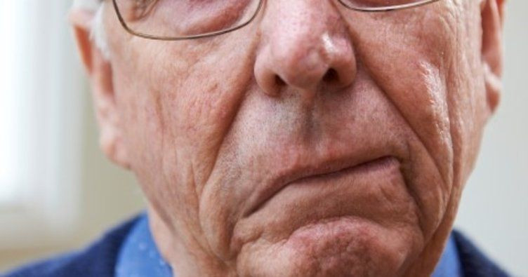 İnme belirtileri neler? Yılda 6 milyon kişi inme nedeniyle ölüyor! - Resim: 3