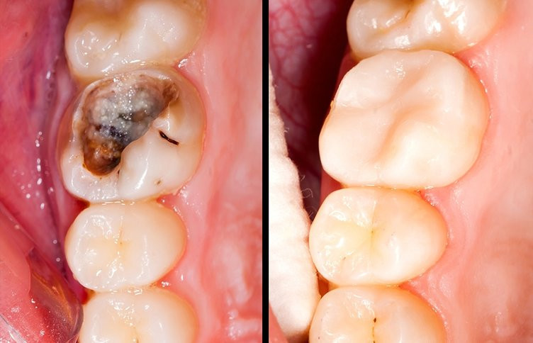 Çürük dişlerin yenilenmesini sağlıyor! - Resim: 1