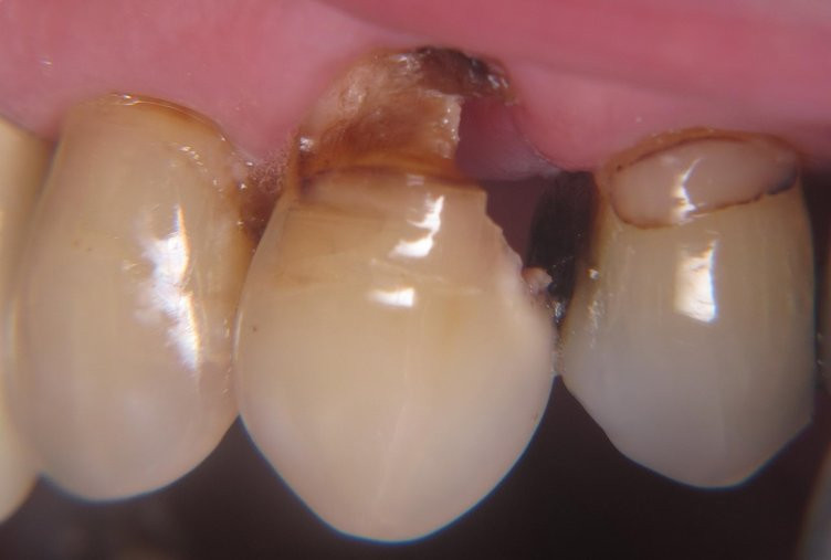 Çürük dişlerin yenilenmesini sağlıyor! - Resim: 3