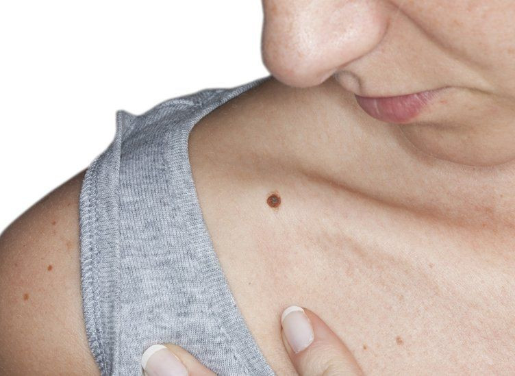 Ciltteki benler tehlikeli mi ne zaman doktora gidilmeli deri kanseri olabilir! - Resim: 1