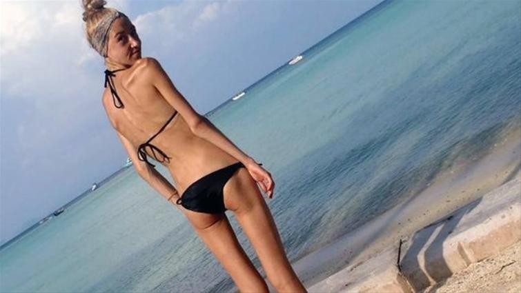 Anoreksiyadan kurtulan genç kızın mucizevi değişimi - Resim: 1