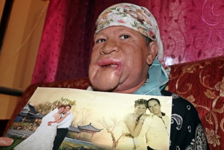 Çenesinde çıkan sivilce hayatını kabusa çevirdi! - Resim: 3