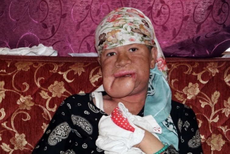 Çenesinde çıkan sivilce hayatını kabusa çevirdi! - Resim: 4