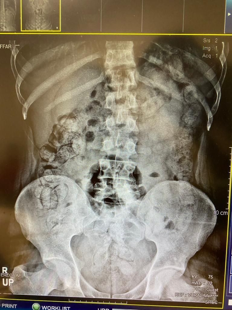 İran uyruklu 5 şüpheli doktorları ve polisleri şaşkına çevirdi! Kolonoskopi yöntemiyle yapmışlar - Resim: 1