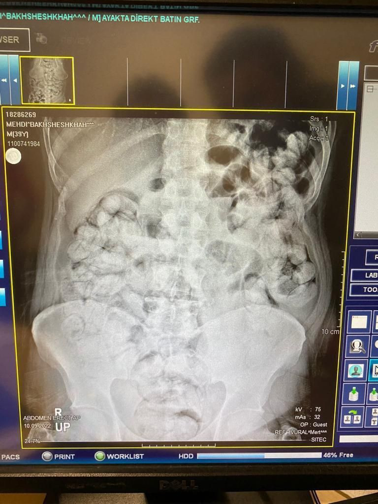 İran uyruklu 5 şüpheli doktorları ve polisleri şaşkına çevirdi! Kolonoskopi yöntemiyle yapmışlar - Resim: 2