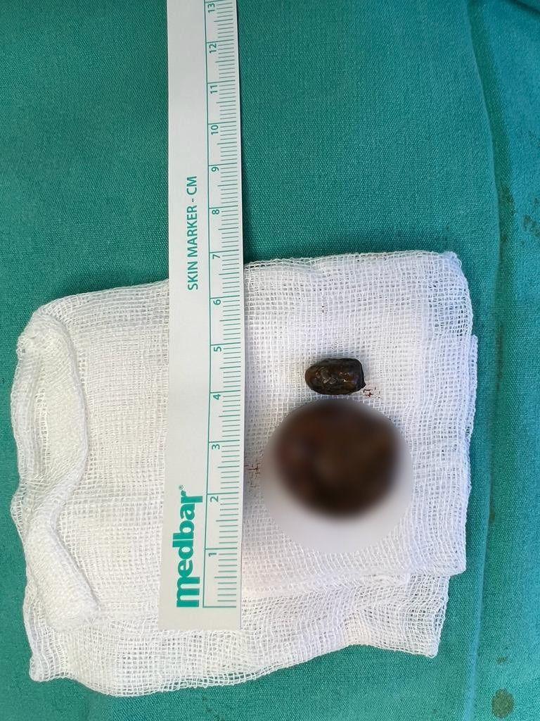 50 yıldır burnunun içindeymiş! 2 saatlik operasyonla çıkarıldı doktor da şoke oldu - Resim: 3