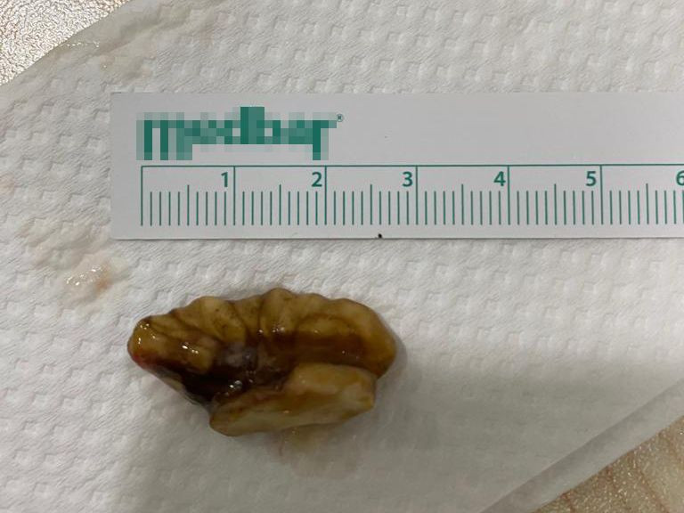 Bursa'da koronavirüs zannettiler gerçek başka çıktı! Akciğerinde ceviz tespit edildi - Resim: 4