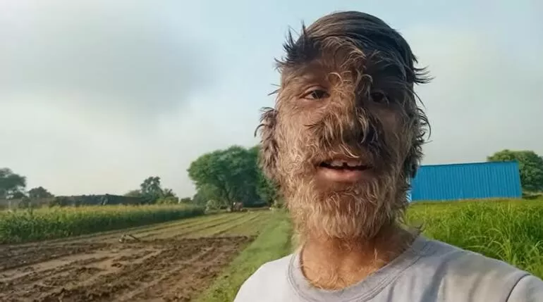 Sadece 50 kişide görülen hastalık! Kurt Adam hayat hikayesini anlattı: "İnsanlar üzerime taş atardı, hayalim Youtuber olmak" - Resim: 4