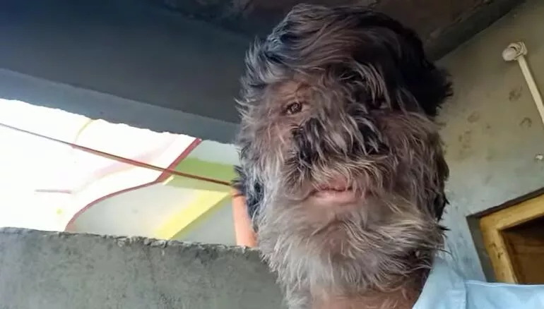 Sadece 50 kişide görülen hastalık! Kurt Adam hayat hikayesini anlattı: "İnsanlar üzerime taş atardı, hayalim Youtuber olmak" - Resim: 3